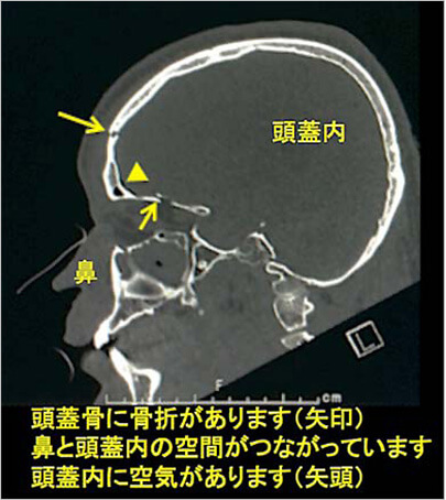 髄液鼻漏、髄液耳漏